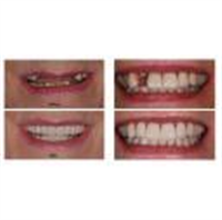 Full Mouth Dental Implants Turkey in Kensington