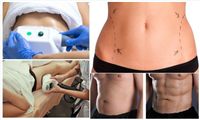 Fat freezing Buckinghamshire in Durham